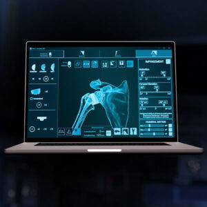 Exactech Equinoxe Planning App