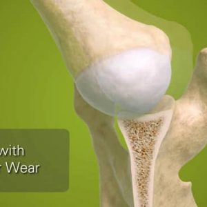 Exactech Equinoxe Glenoid Components for Posterior Wear in Shoulder Arthroplasty - 718-00-02