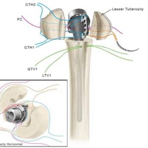 Exactech Equinoxe Shoulder Platform Fracture Suture Animation - 12-0000698